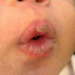 Bibir Kering Pada Bayi