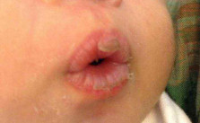 Bibir Kering Pada Bayi