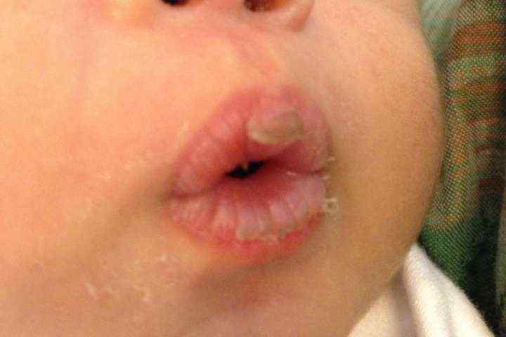 Bibir Kering Pada Bayi