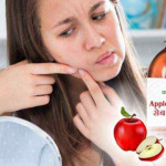 Cara Mudah Mengatasi Jerawat Dengan Cuka Apel