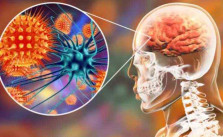 Penyakit Meningitis